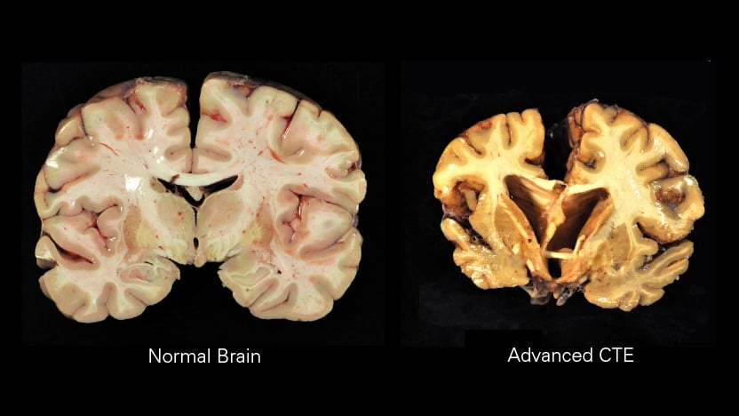 (Courtesy of Boston University Center for the Study of Traumatic Encephalopathy)