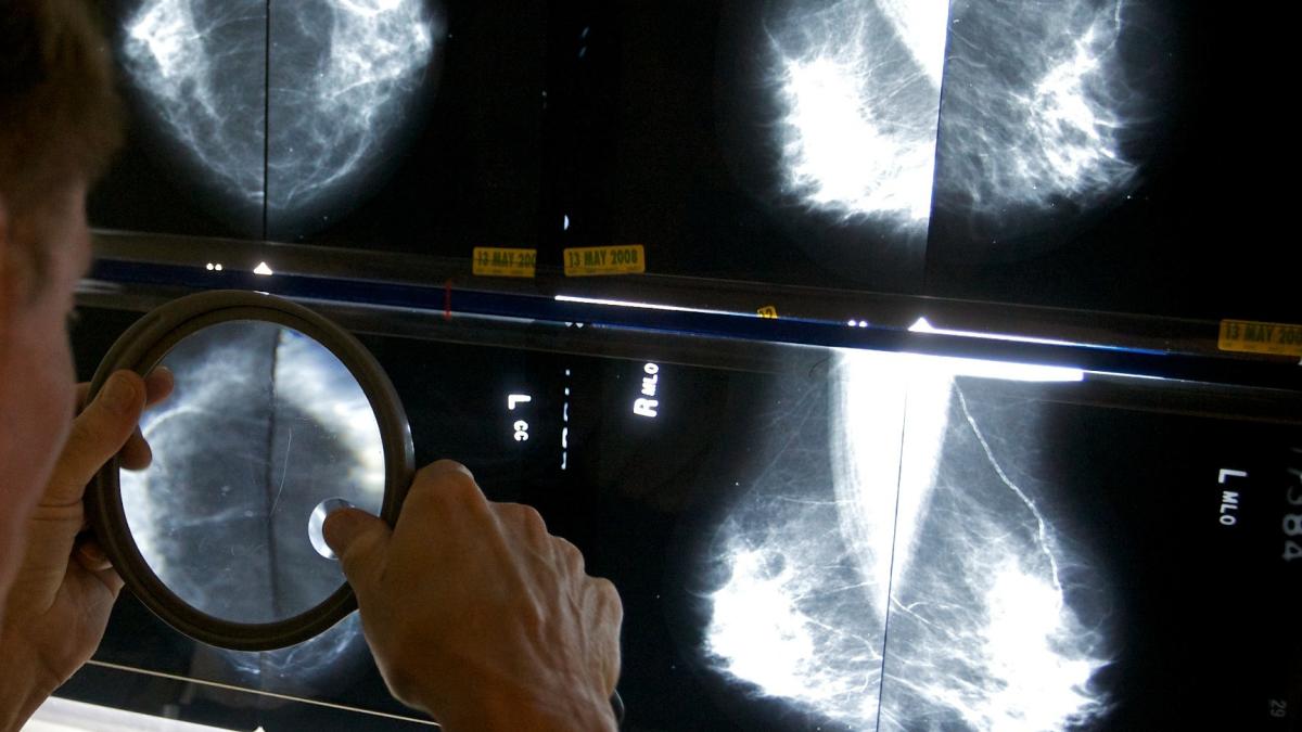 A radiologist uses a magnifying glass to check mammograms for breast cancer in Los Angeles, May 6, 2010. (AP Photo / Damian Dovarganes, File)