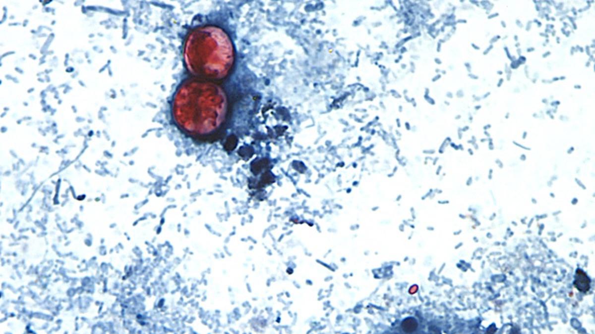 This undated photo taken through a microscope provided by the CDC shows Cyclospora cayetanensis oocysts found in a fresh stool sample which had been prepared with a formalin solution and stained with safranin. (CDC via AP)