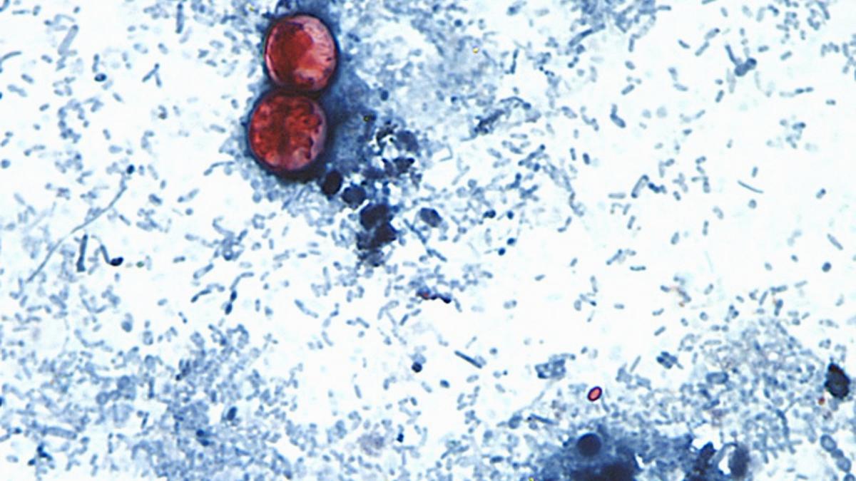 This undated photo taken through a microscope and provided by the CDC shows Cyclospora cayetanensis oocysts found in a fresh stool sample which had been prepared with a formalin solution and stained with safranin. (CDC via AP, File)