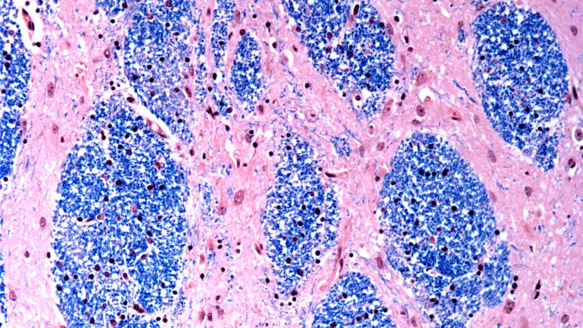 This microscope photo provided by the McLean Hospital's Harvard Brain Tissue Resource Center in January 2024 shows cells in the caudate nucleus structure of the brain in a person with Huntington's disease. (McLean Hospital's Harvard Brain Tissue Resource Center / NIH NeuroBioBank via AP)