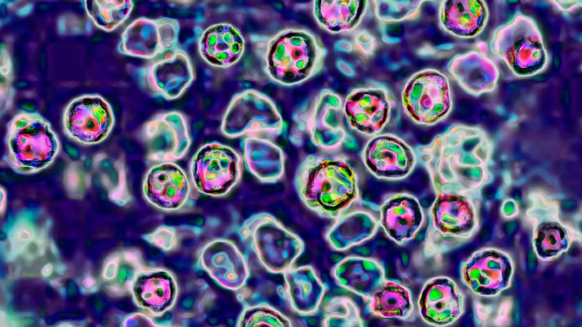 This photo shows a microscopic view of the measles virus. (BSIP / Universal Images Group / Getty Images via CNN Newsource)