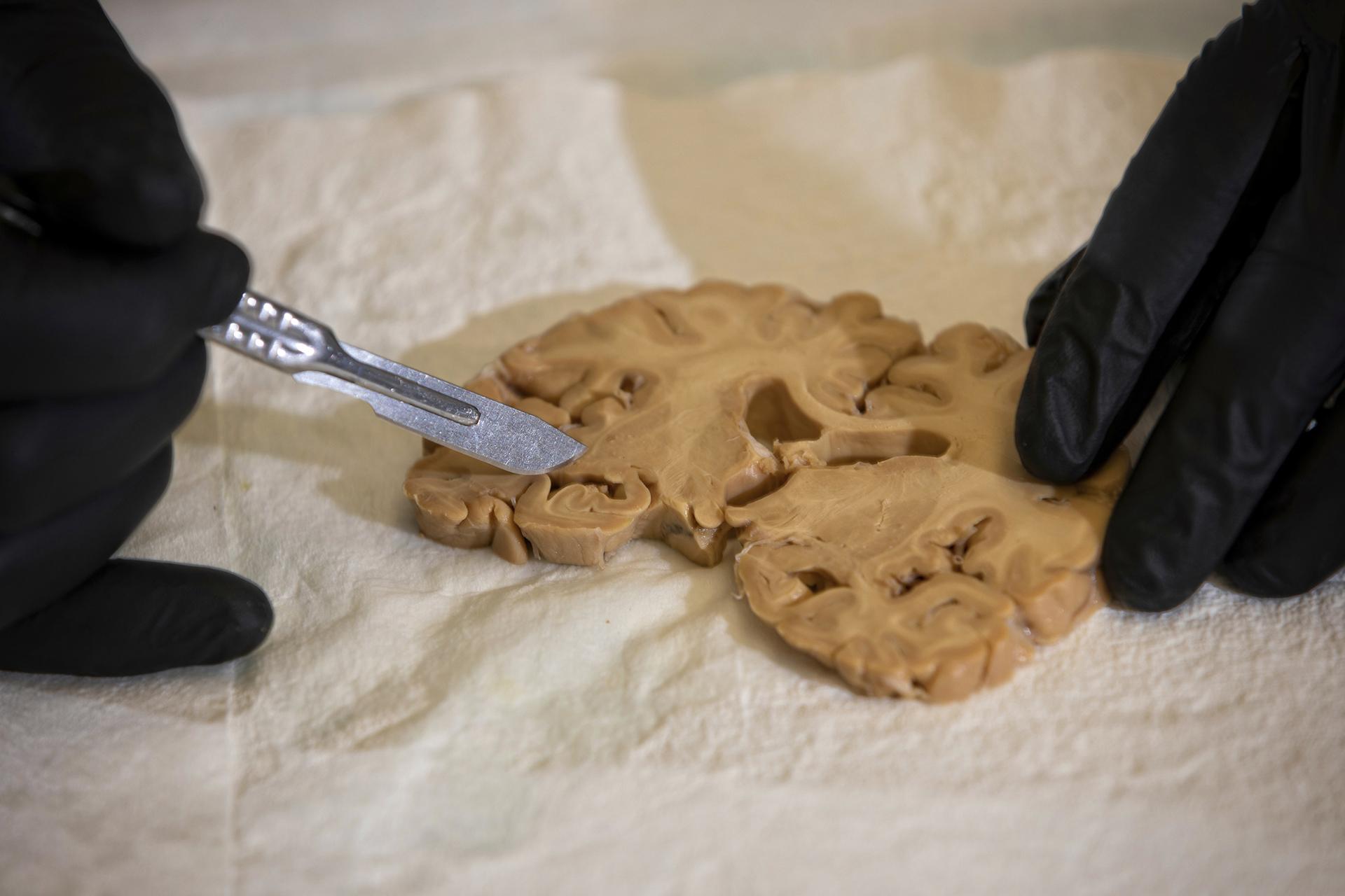 In this April 29, 2019 photo provided by the University of Kentucky, Dr. Peter T. Nelson inspects a section of brain in the neuropathology lab at the Sanders-Brown Center for Aging in Lexington, Kentucky (Mark Cornelison / University of Kentucky via AP)