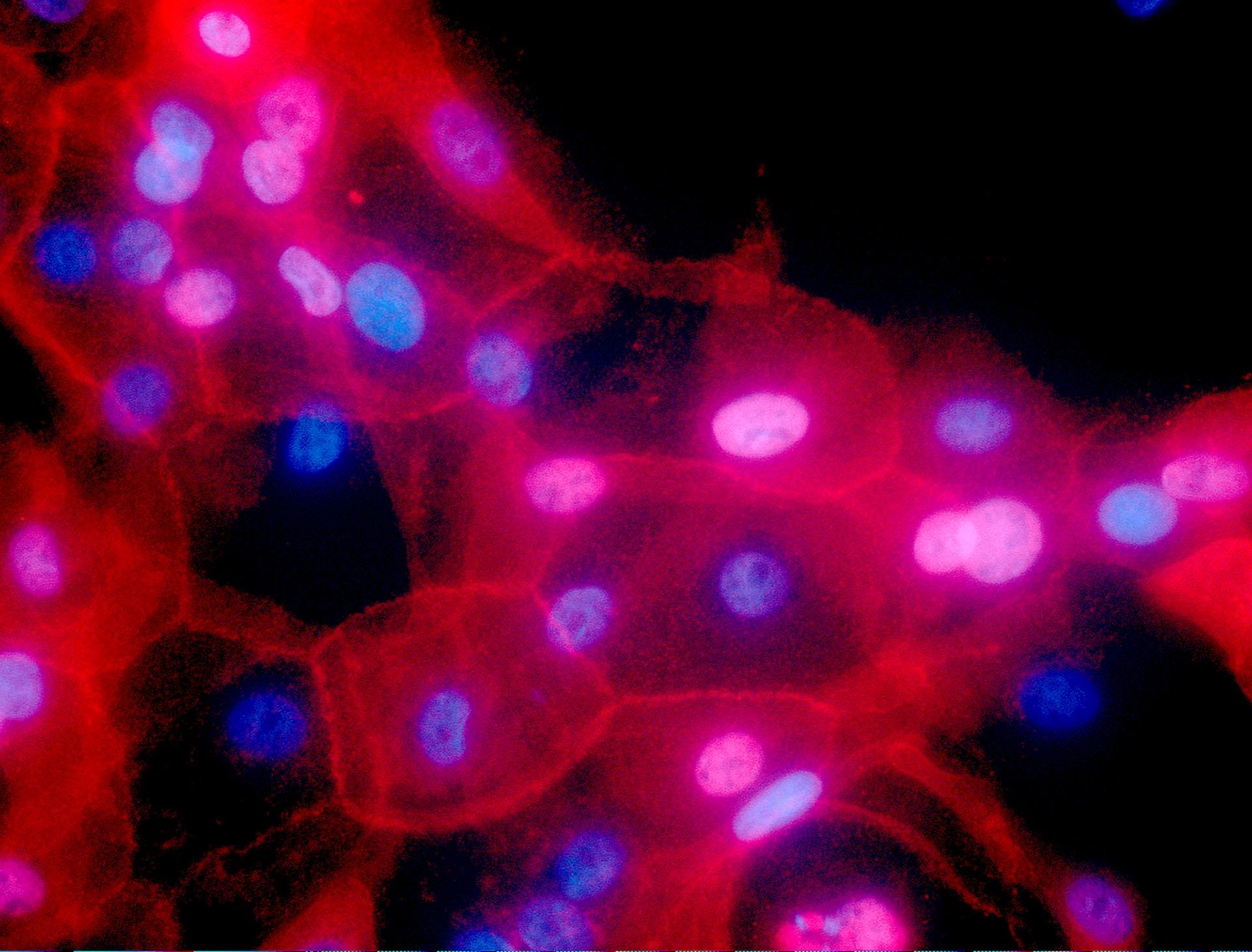 This undated fluorescence-colored microscope image made available by the National Institutes of Health in September 2016 shows a culture of human breast cancer cells. (Ewa Krawczyk / National Cancer Institute via AP)