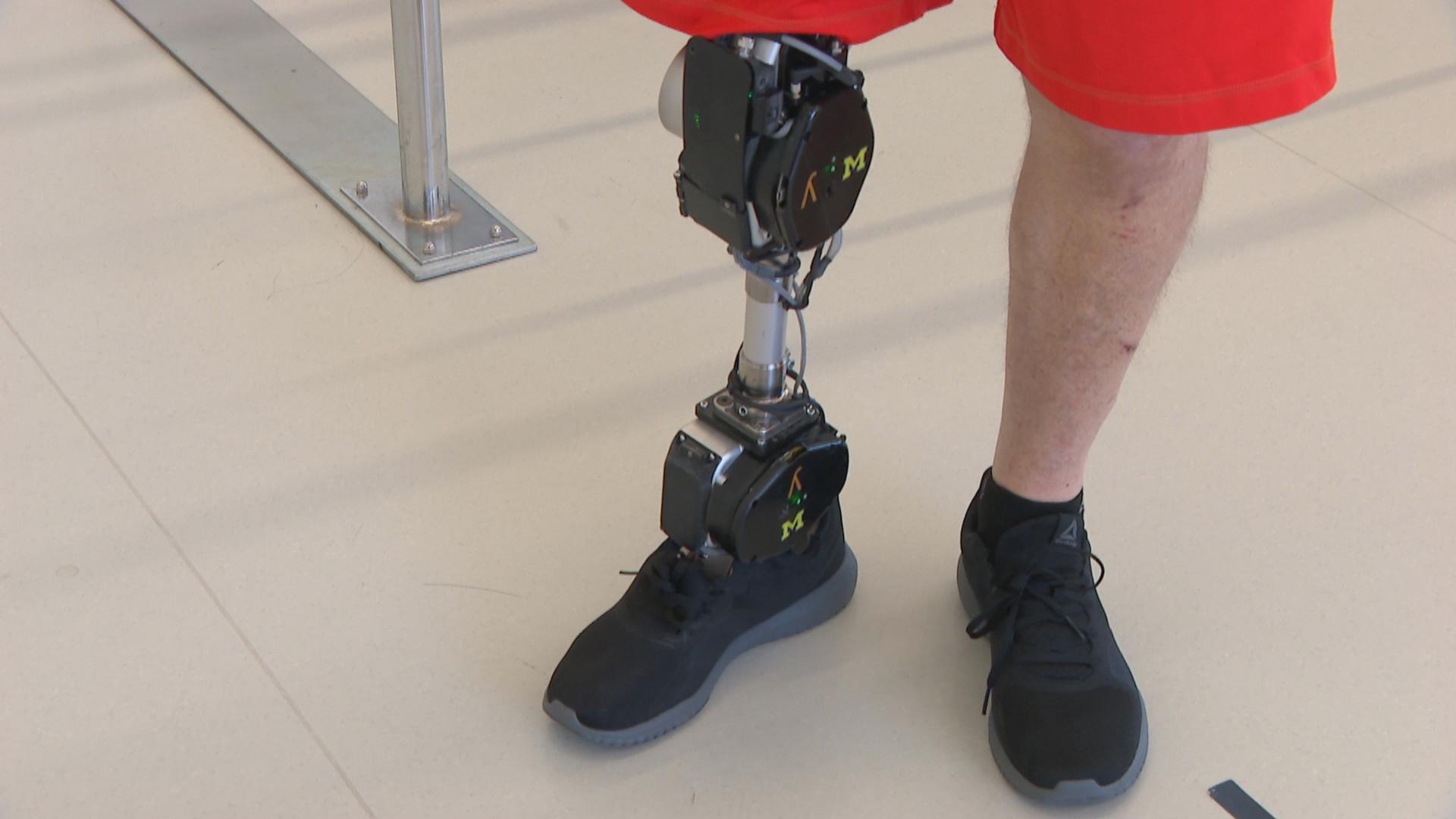 This Is What It's Like To Live With A Prosthetic Leg