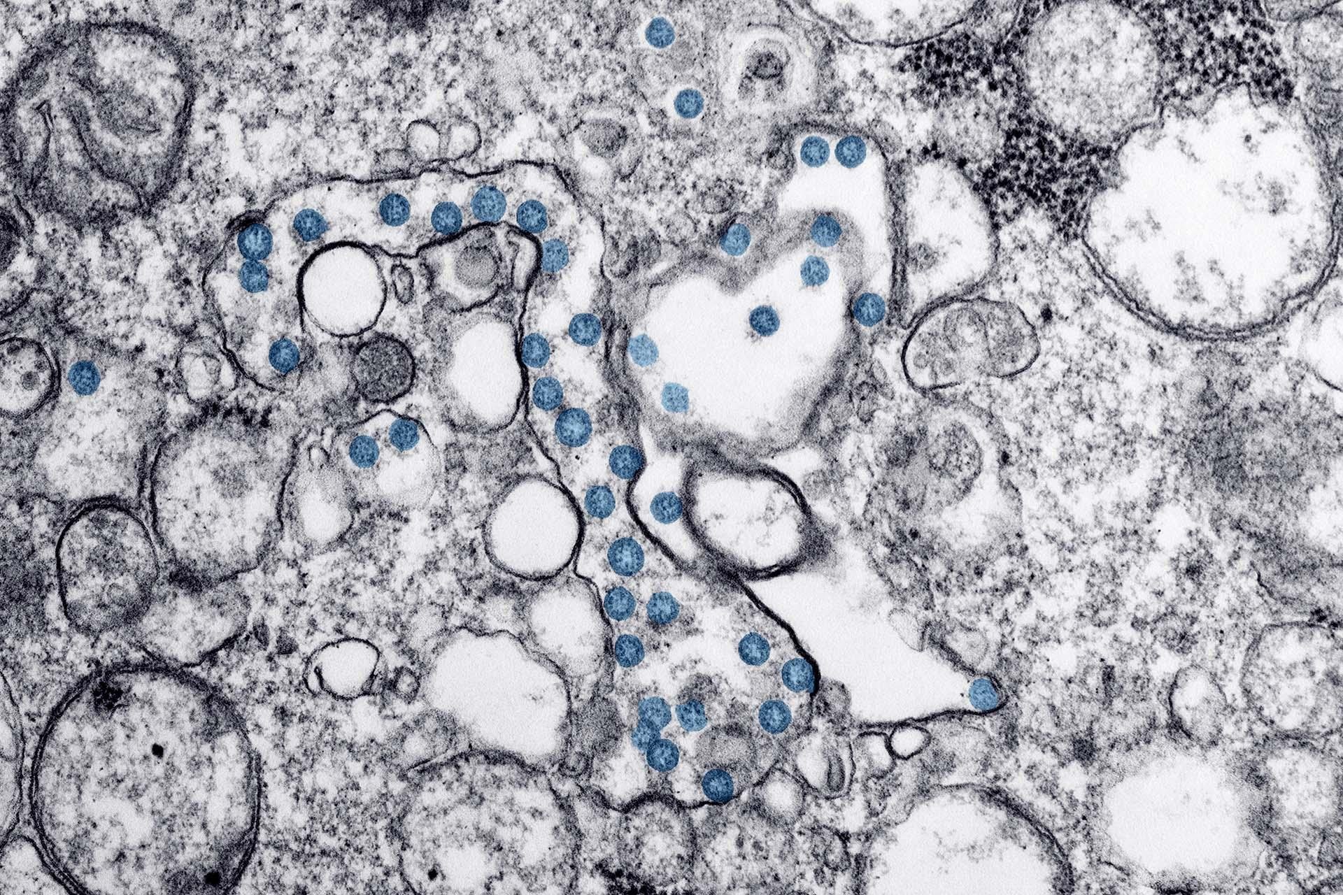 This image from a transmission electron microscopic image shows a sample from the first U.S. case of COVID-19. The spherical viral particles, colored blue, contain cross-sections through the viral genome, seen as black dots. (Image provided by the U.S. Centers for Disease Control and Prevention)