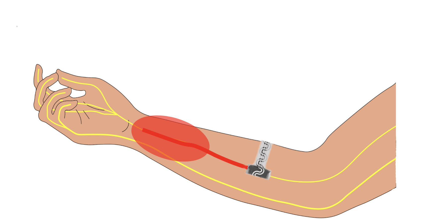 Researchers at Northwestern University have developed a small and flexible implant, pictured in this rendering, that can relieve pain without drugs. (Credit: Northwestern University)