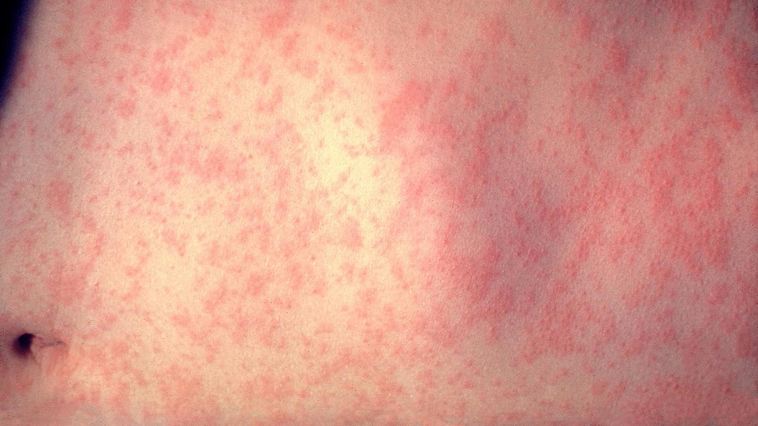 The skin of a patient three days after developing a measles infection. (Dr. Heinz F. Eichenwald / Centers for Disease Control and Prevention)