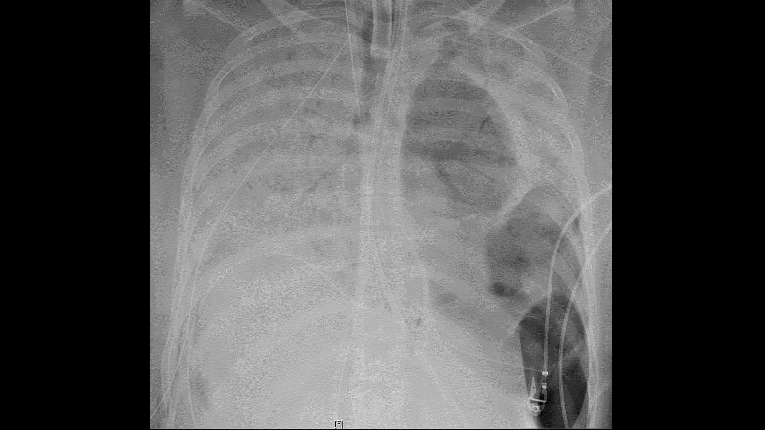 A 20-year-old woman spent six weeks on a ventilator and life-support machine as she battled the novel coronavirus, which so severely damaged her lungs she needed a double lung transplant. (©Copyright 2020, Northwestern Medicine)