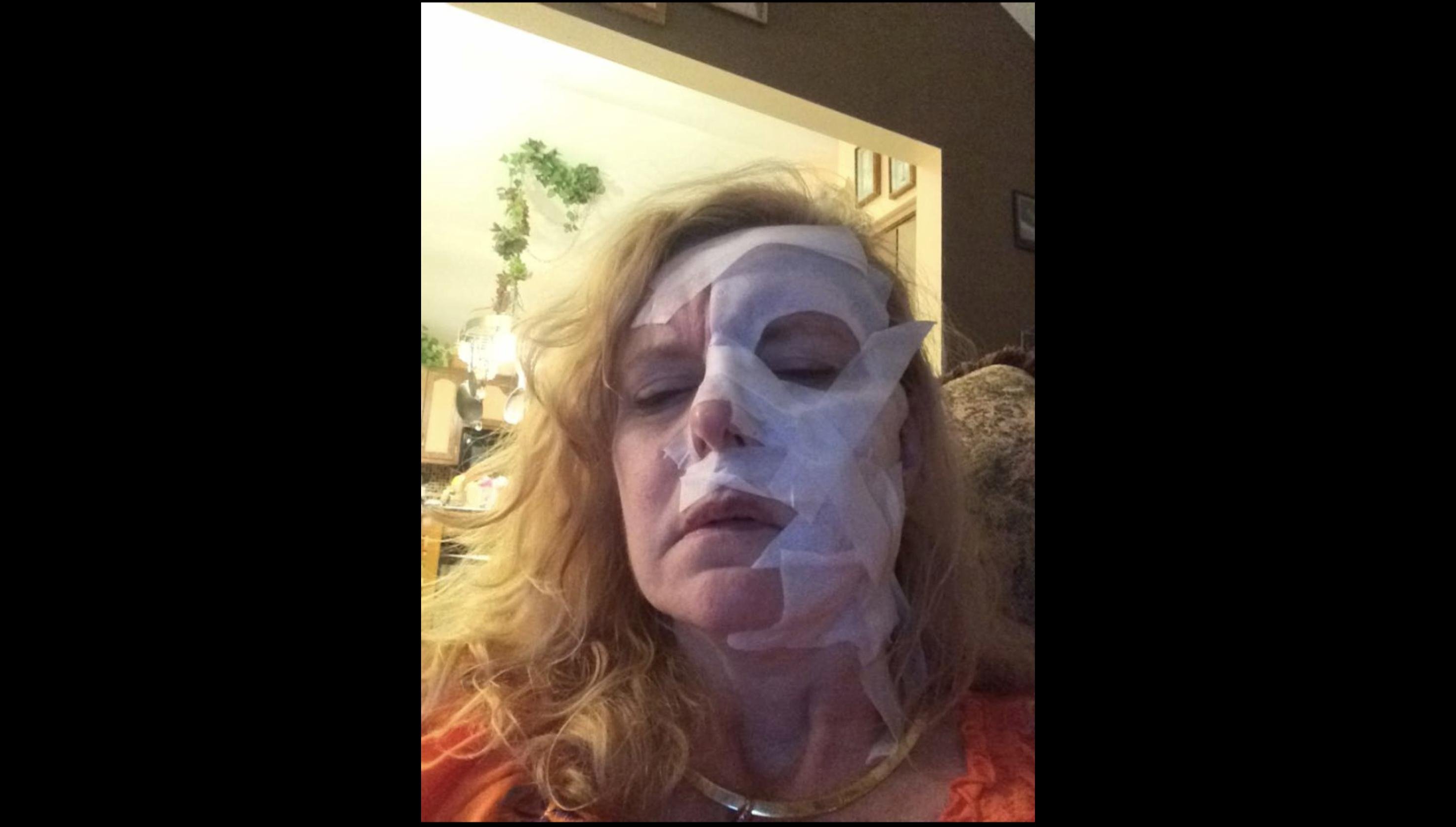 Rene Urbanek says she uses Lidocaine patches on her face to numb her skin when it feels like it’s “burning on fire.” (Courtesy of Rene Urbanek)