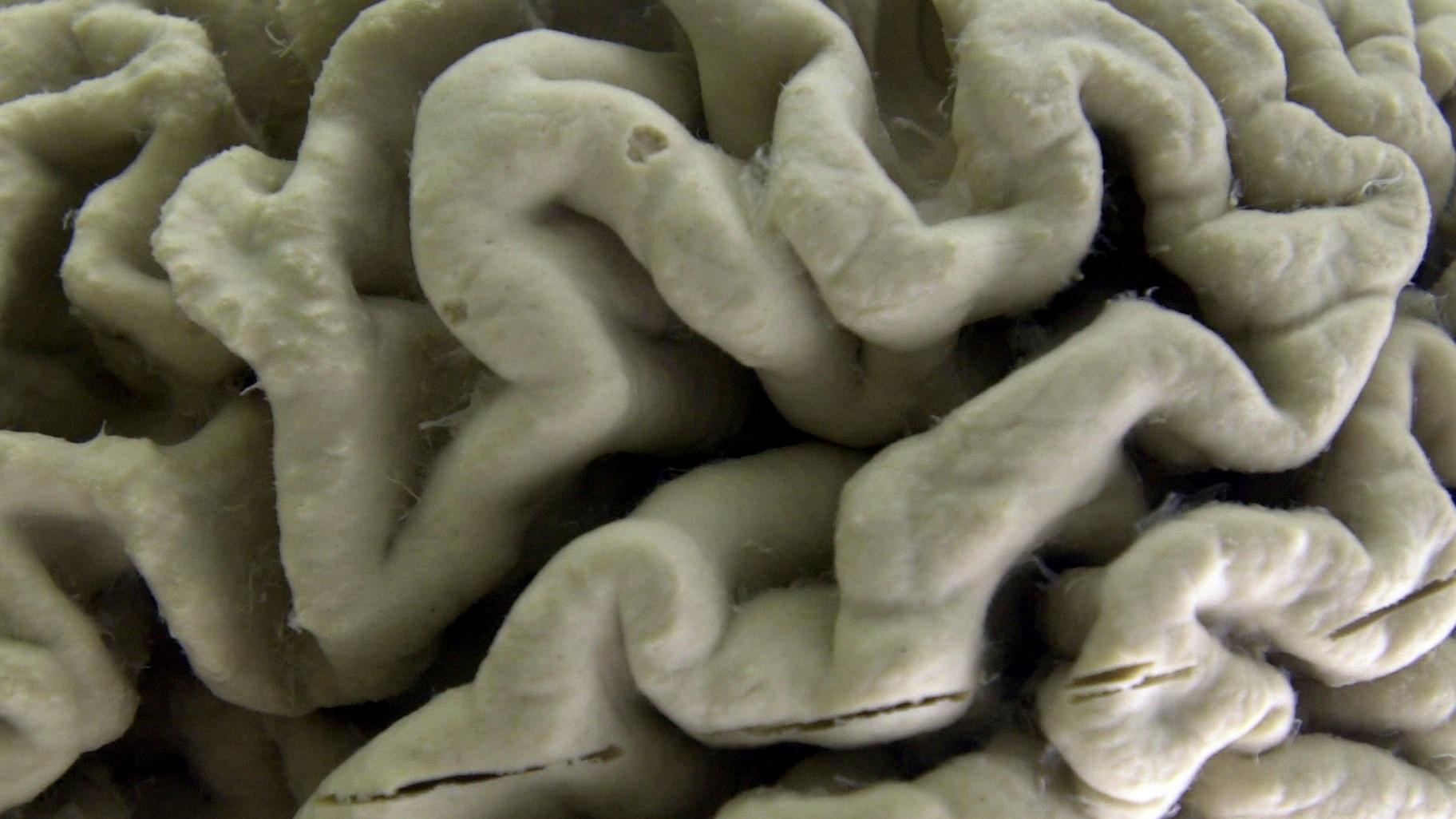 A section of a human brain with Alzheimer’s disease is displayed at the Museum of Neuroanatomy at the University at Buffalo, in Buffalo, N.Y., Oct. 7, 2003. (AP Photo / David Duprey, File)