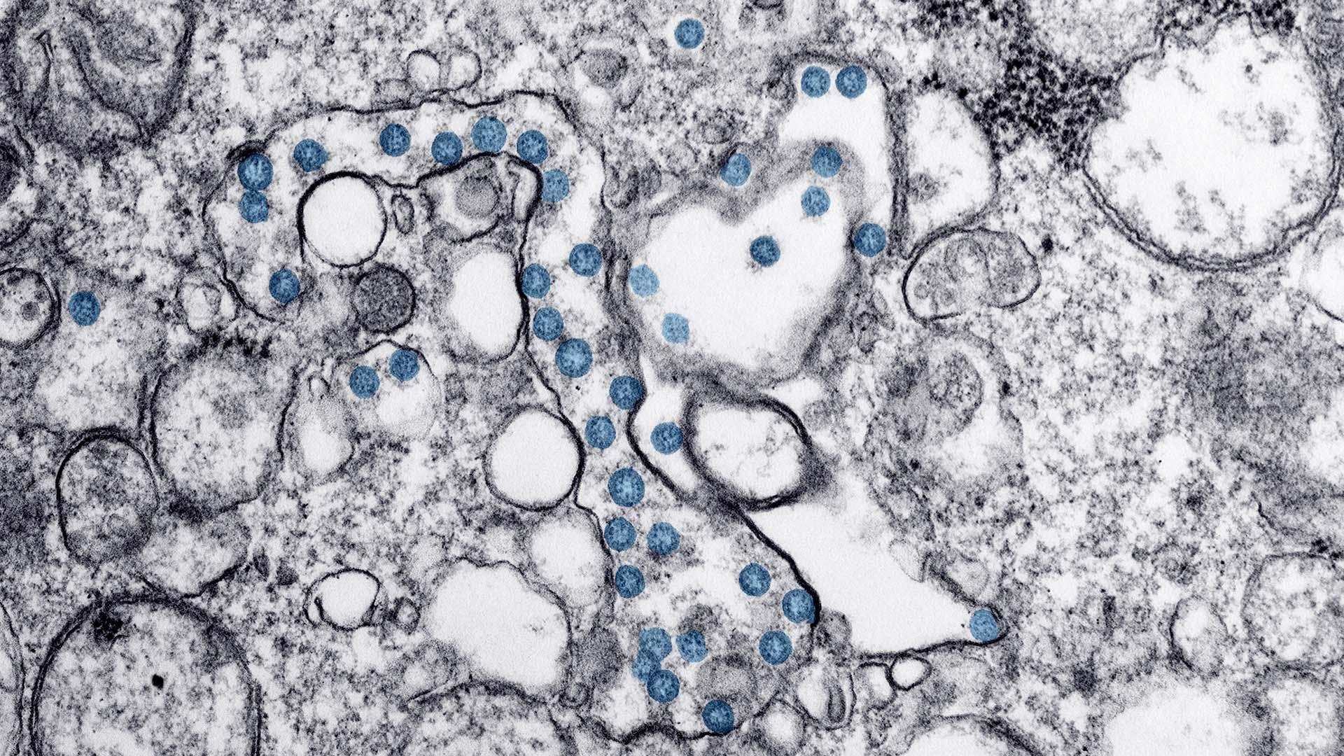 This image from a transmission electron microscopic image shows a sample from the first U.S. case of COVID-19. The spherical viral particles, colored blue, contain cross-sections through the viral genome, seen as black dots. (Image provided by the U.S. Centers for Disease Control and Prevention)