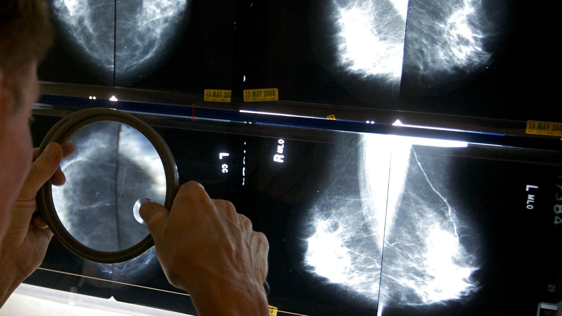 FILE - A radiologist uses a magnifying glass to check mammograms for breast cancer in Los Angeles, May 6, 2010. (Damian Dovarganes / AP Photo, File)