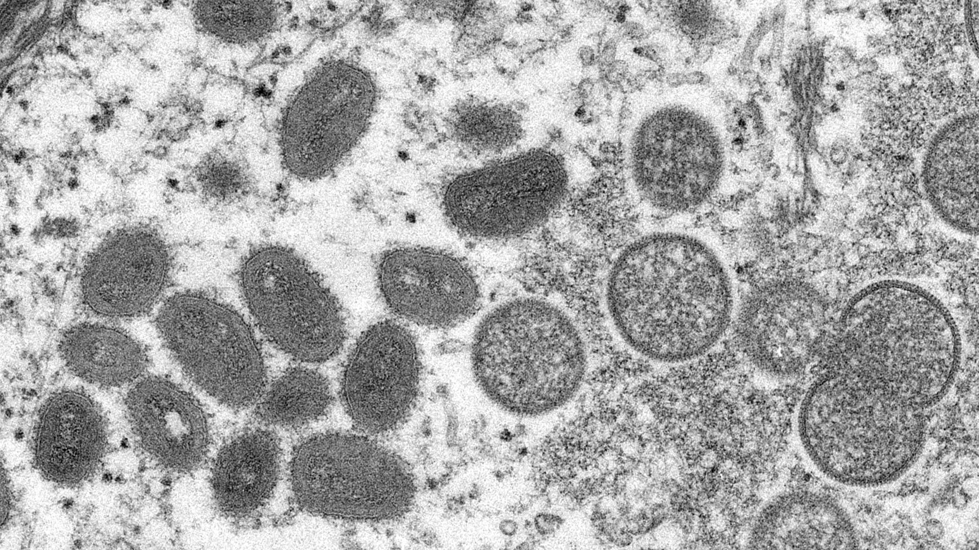 This electron microscope image shows mature, oval-shaped mpox virions, left, and spherical immature virions, right, from a human skin sample associated with a 2003 prairie dog outbreak. (Cynthia S. Goldsmith, Russell Regnery / CDC)