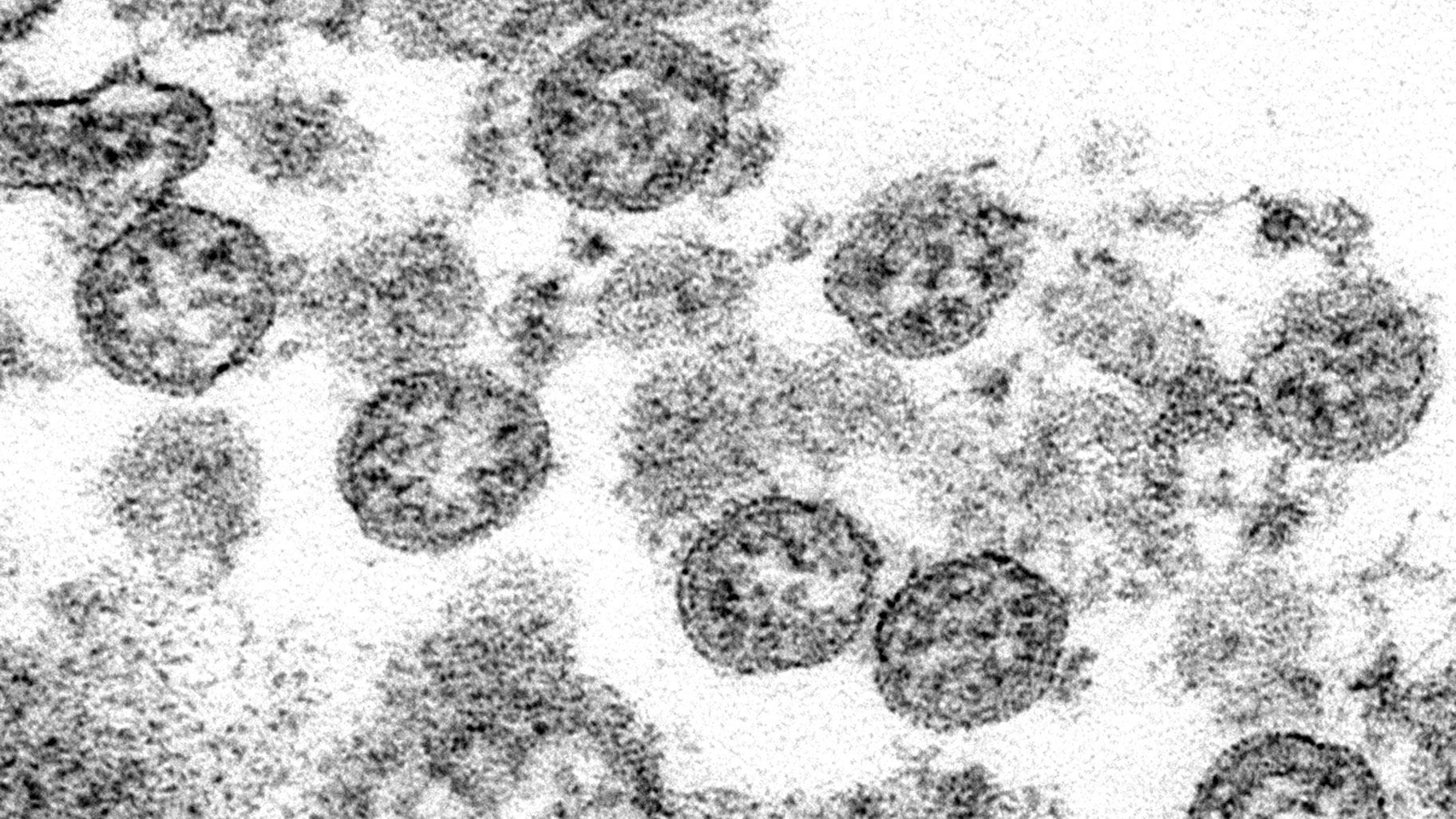 This 2020 electron microscope image made available by the U.S. Centers for Disease Control and Prevention shows the spherical coronavirus particles from what was believed to be the first U.S. case of COVID-19. (C.S. Goldsmith, A. Tamin / CDC via AP)