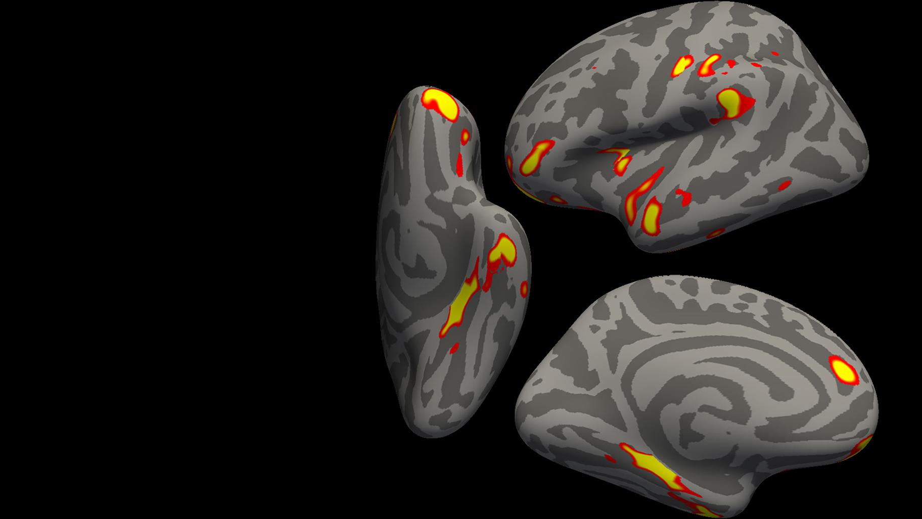 The red-yellow regions are the parts of the brain that shrink the most in the 401 SARS- CoV-2 infected participants, compared with the 384 non-infected participants. (Credit: G. Douaud, in collaboration with Anderson Winkler and Saad Jbabdi, University of Oxford and NIH via CNN)