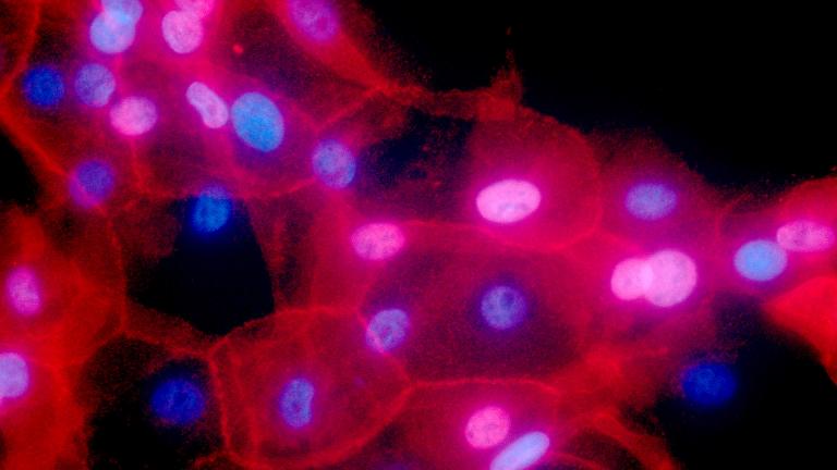 This undated fluorescence-colored microscope image made available by the National Institutes of Health in September 2016 shows a culture of human breast cancer cells. (Ewa Krawczyk / National Cancer Institute via AP)