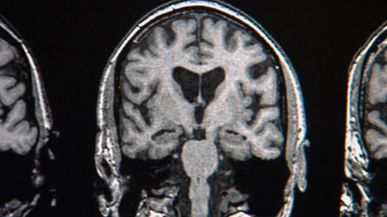An image of the brain of a patient with Alzheimer’s disease. (WTTW News)