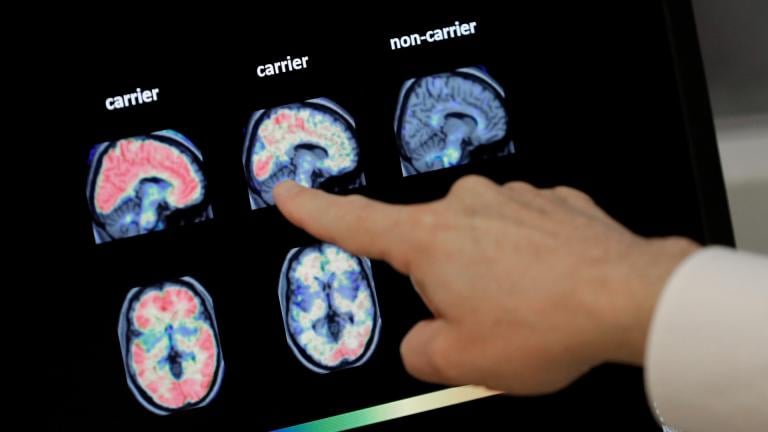 A doctor looks at PET brain scans at Banner Alzheimers Institute in Phoenix on Aug. 14, 2018. (AP Photo / Matt York, File)
