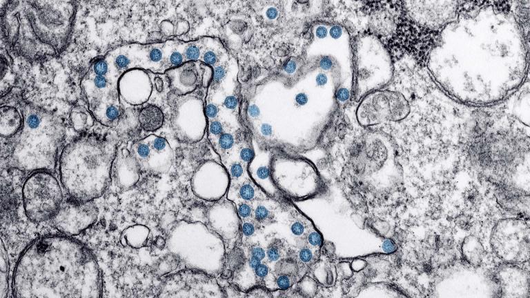 This image from a transmission electron microscopic image shows a sample from the first U.S. case of COVID-19. The spherical viral particles, colored blue, contain cross-sections through the viral genome, seen as black dots. (Image provided by the U.S. Centers for Disease Control and Prevention)