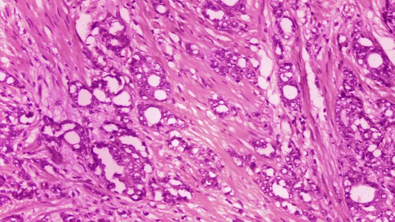 This 1974 microscope image made available by the Centers for Disease Control and Prevention shows changes in cells indicative of adenocarcinoma of the prostate. (Dr. Edwin P. Ewing, Jr. / CDC via AP)