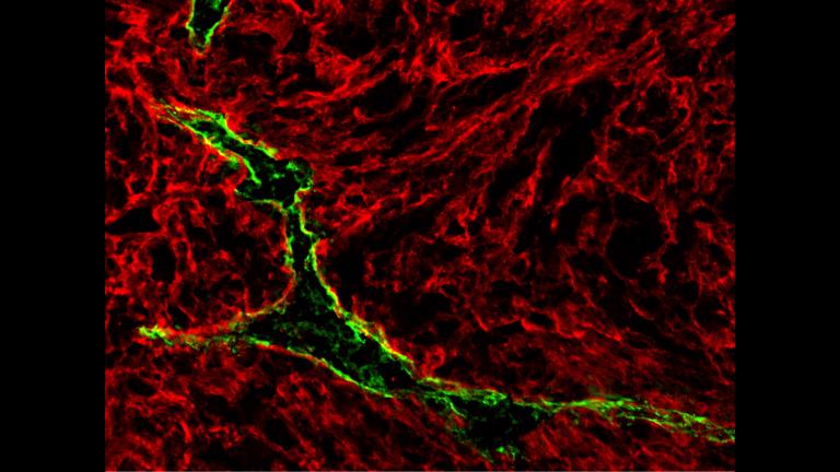 A lymphatic vessel (green) inside a Braf-driven primary mouse melanoma tumor. (Manuel Fankhauser and Maria Broggi / EPFL)