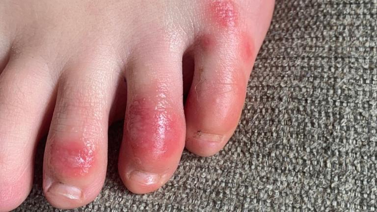 This April 3, 2020 photo provided by Northwestern University shows discoloration on a teenage patient’s toes at the onset of the condition informally called “COVID toes.” (Courtesy of Dr. Amy Paller / Northwestern University via AP)