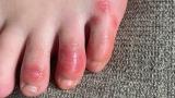 This April 3, 2020 photo provided by Northwestern University shows discoloration on a teenage patient’s toes at the onset of the condition informally called “COVID toes.” (Courtesy of Dr. Amy Paller / Northwestern University via AP) This April 3, 2020 photo provided by Northwestern University shows discoloration on a teenage patient’s toes at the onset of the condition informally called “COVID toes.” (Courtesy of Dr. Amy Paller / Northwestern University via AP)