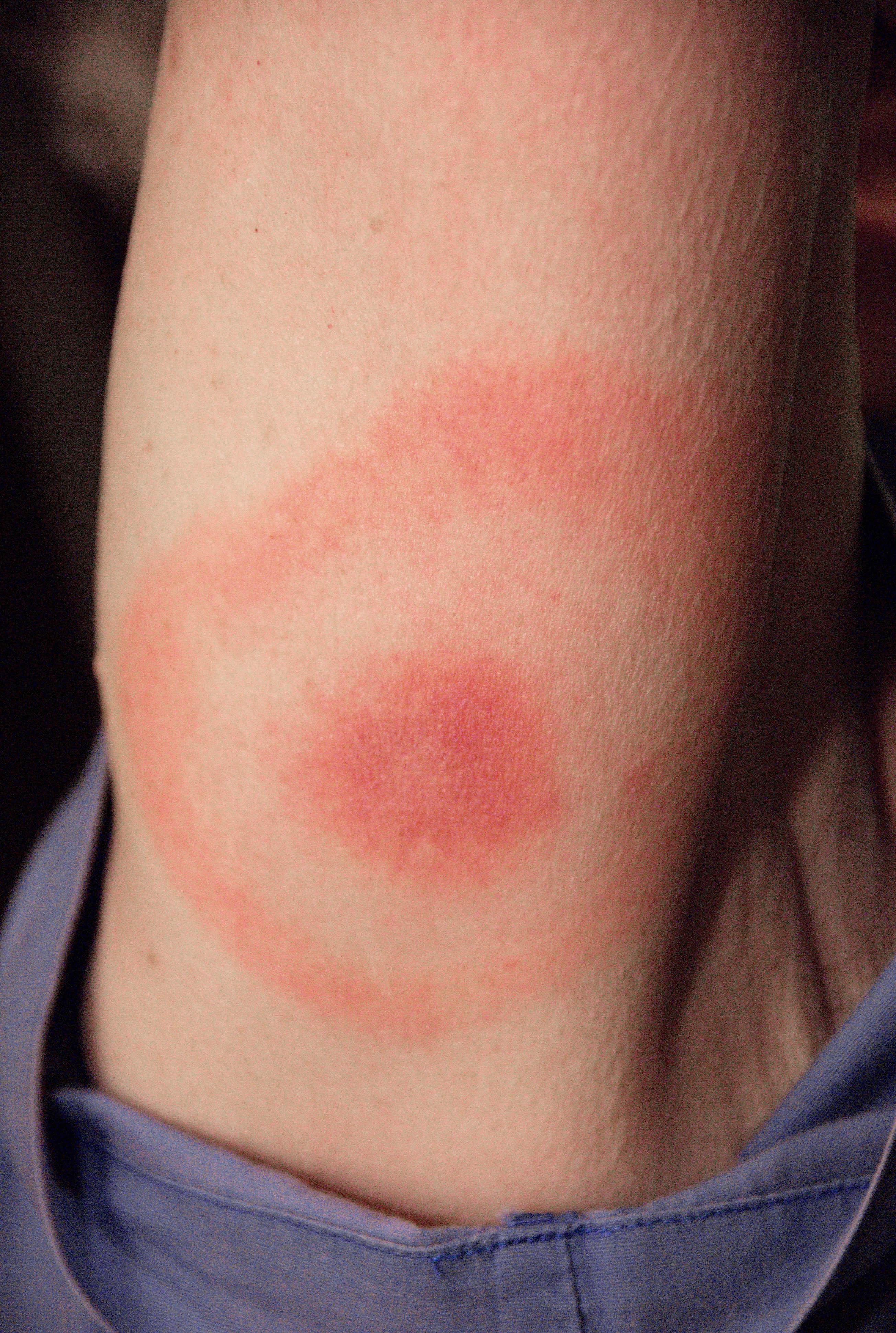 Pictured is the characteristic bull’s-eye rash, which manifested at the site of a tick bite on a woman in Maryland. (James Gathany / CDC)