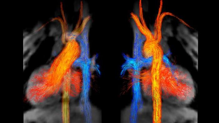 Kelly Jarvis’ “Blood Flow in Fontan Circulation” won first place. 