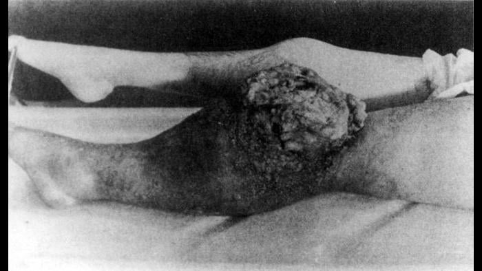 Dial painter with radium-induced cancer of the knee. (Lippincott, Williams, and Wilkins, sourced from Deadly Glow)