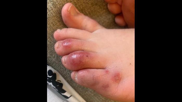 This April 6, 2020 photo provided by Northwestern University shows discoloration on a teenage patient’s toes three days after the onset of the condition informally called “COVID toes.” (Courtesy of Dr. Amy Paller / Northwestern University via AP)