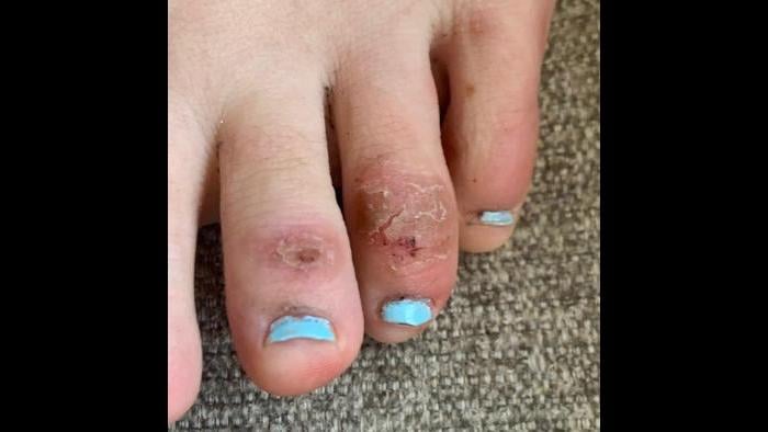 This April 21, 2020 photo provided by Northwestern University shows discoloration on a teenage patient’s toes four weeks after the onset of the condition informally called “COVID toes.” (Courtesy of Dr. Amy Paller / Northwestern University via AP)
