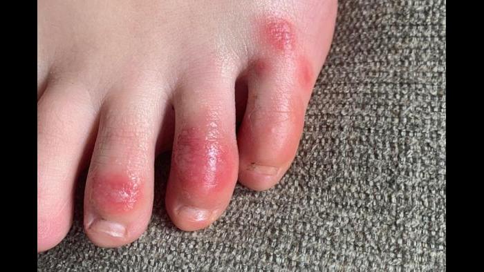 This April 3, 2020 photo provided by Northwestern University shows discoloration on a teenage patient’s toes at the onset of the condition informally called “COVID toes.” (Courtesy of Dr. Amy Paller / Northwestern University via AP)