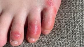 This April 3, 2020 photo provided by Northwestern University shows discoloration on a teenage patient’s toes at the onset of the condition informally called “COVID toes.” (Courtesy of Dr. Amy Paller / Northwestern University via AP) This April 3, 2020 photo provided by Northwestern University shows discoloration on a teenage patient’s toes at the onset of the condition informally called “COVID toes.” (Courtesy of Dr. Amy Paller / Northwestern University via AP)